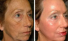 2 helppoa tapaa poistaa ryppyjä kasvojen kotona ilman leikkausta ja ilman kosmetologi
