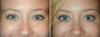 Mikä yhdistelmä kosmeettisia menettelyjä bombichesky vaikutus naamasi