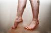 Rikkoo verenkiertoa jaloissa: syyt, oireet