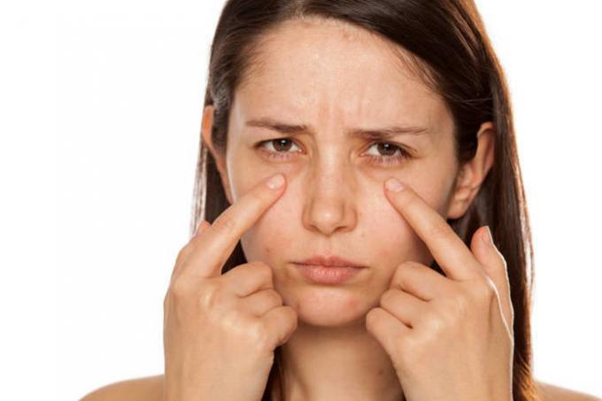 Miten päästä eroon mustelmia silmien alla 10 minuuttia?