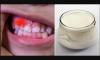 Miten estää hampaiden reikiintymistä ja vahvistaa immuunijärjestelmää