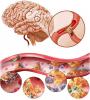 Cerebral ateroskleroosi: miten käsitellä, mitkä ovat oireet?