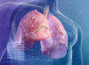 Kasvain keuhkoissa: 5 Signs