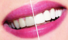 Miten valkaista hampaat kotona? hammaslääkärin neuvoja.