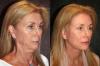 Miten ovat tavallisia naisia ​​50-70 vuotta vanhoja, jotka ovat tehneet kasvojenkohotuksen