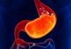 Te gastriitti: 6 ei-ilmeisiä merkkejä