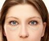 Miten päästä eroon ilman leikkausta, tyrä ja alaluomea silmä pussit