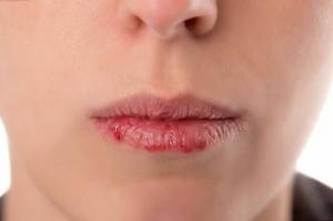 5 vinkkejä, miten ehkäistä chapping huulet